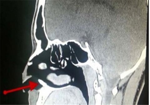 پسر 22 ساله که در بینی اش دندان دارد! (+عکس)