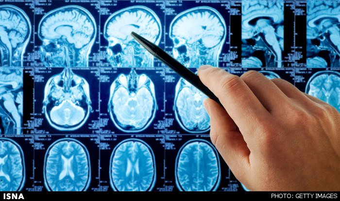 استرس شدید چگونه مغز را به جنون می‌کشد؟