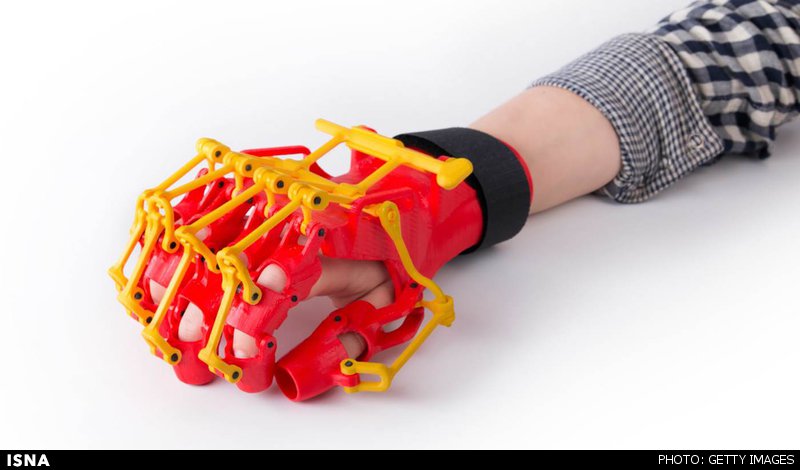 ساخت ارتز دست با فناوری چاپ سه‌ بعدی