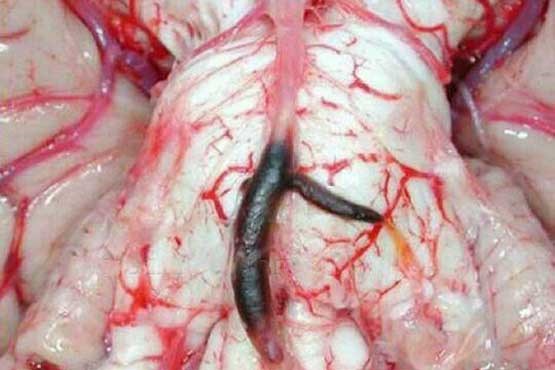 مغز بعد از سکته شدید+تصویر مغز بعد از سکته شدید+تصویر