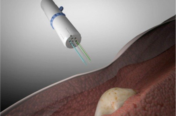 ابداع روشی نوین برای درمان سرطان سینه