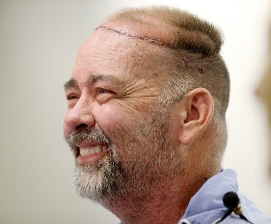 انجام نخستین پیوند موفق جمجمه و پوست سر انسان انجام نخستین پیوند موفق جمجمه و پوست سر انسان