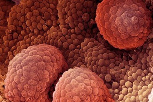 تلاش برای درمان سرطان با نانوحاملهای هوشمند تلاش برای درمان سرطان با نانوحاملهای هوشمند