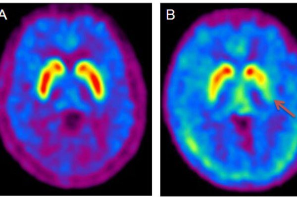 کشف دارویی امیدبخش برای درمان پارکینسون