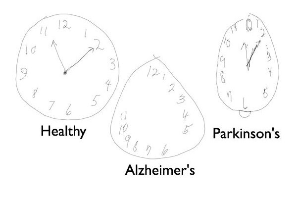 تشخیص آلزایمر و زوال عقل با قلم دیجیتالی