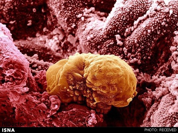 ارائه روشی موثر برای درمان سرطان سینه
