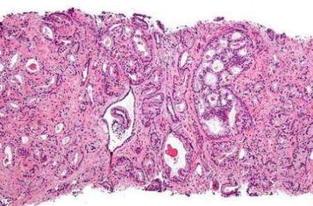 اميد تازه براي درمان سرطان هاي كشنده پروستات اميد تازه براي درمان سرطان هاي كشنده پروستات