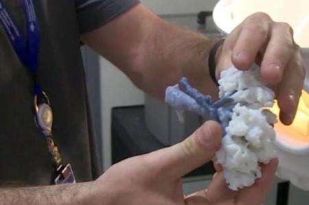 خارج کردن تومور از کلیه با کمک چاپ سه بعدی