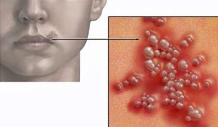 درمان تبخال با اصلاح ژنتیکی درمان تبخال با اصلاح ژنتیکی