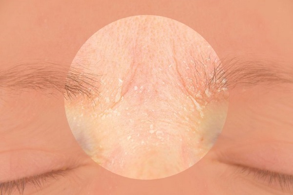 رابطه استرس و شرایط پوست