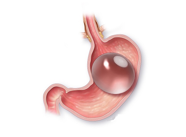 آیا بالون‌های معده آینده کاهش وزن هستند؟