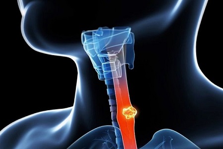 کلینیک سرطان عصر ایران