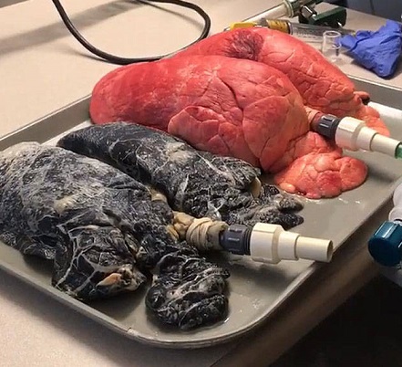 تفاوت ریه یک فرد سالم با یک فرد سیگاری (عکس)