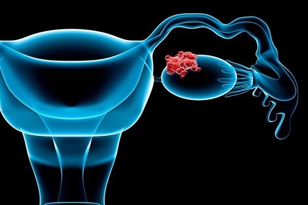 از نشانههای ظریف سرطان تخمدان که شاید نادیده گرفته شوند از نشانههای ظریف سرطان تخمدان که شاید نادیده گرفته شوند