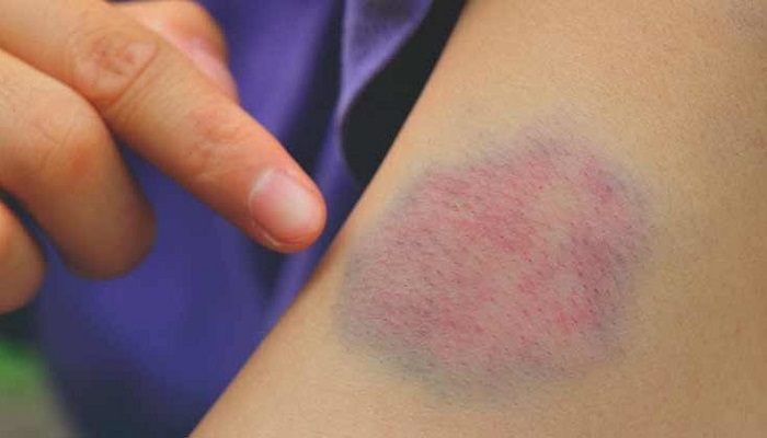 کبودی خارشدار؛ از دلایل تا درمان کبودی خارشدار؛ از دلایل تا درمان