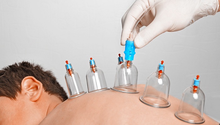 دانستنیهایی درباره حجامت دانستنیهایی درباره حجامت