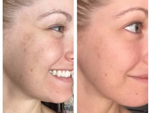 سرم های ویتامین ث، معجزه گران پوست!