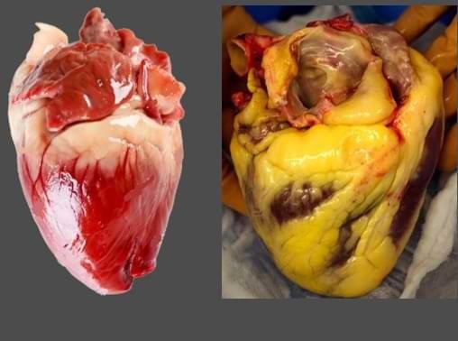 از قلبی که با چربی پوشیده شده تا تهدید سلامت انسان از قلبی که با چربی پوشیده شده تا تهدید سلامت انسان