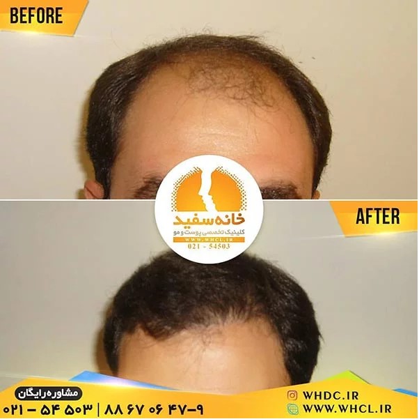 کاشت مو به روش میکروگرافت کاشت مو به روش میکروگرافت