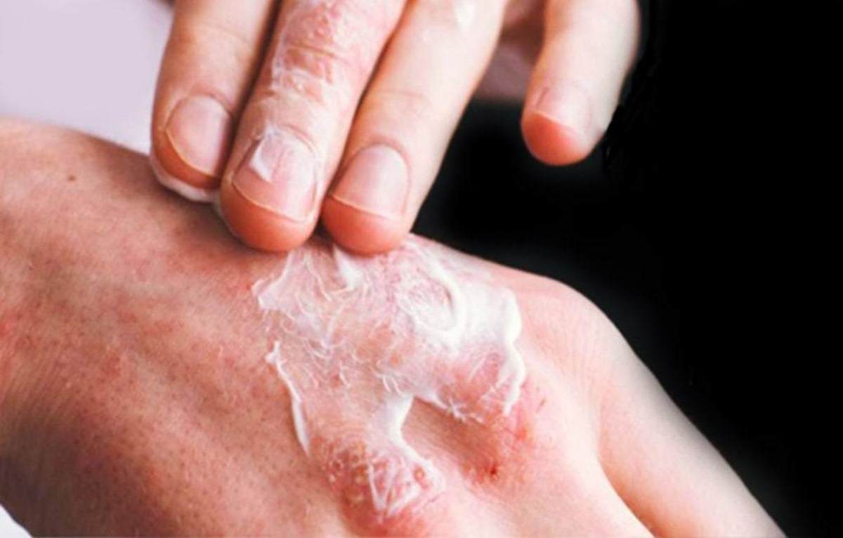 پلاگر چیست؟