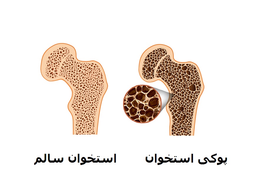 همراه با بهترین رژیم غذایی برای بیماران مبتلا به پوکی استخوان