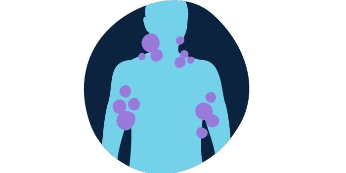 سرطان خون و همه چیز درباره نشانه های آن