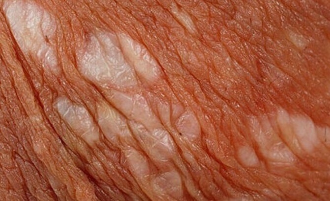 لیکن اسکلروز؛ اختلال التهابی پوست اندام تناسلی / علت، نشانه ها، پیشگری و درمان (+عکس)