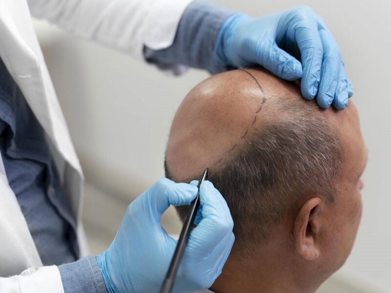 جدیدترین روش های کاشت مو و ابرو در ایران و جهان