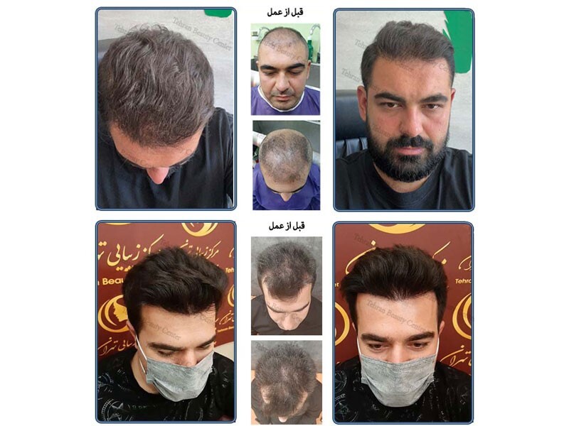 جدیدترین روش های کاشت مو و ابرو در ایران و جهان